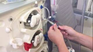 Dialysis twister measurement of arteriovenous fistula flow [upl. by Blackman]