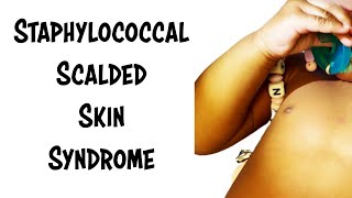 Staphylococcal Scalded Skin Syndrome [upl. by Riada]