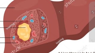 Medicine part Liver Abscess by sasi sir 20810517 [upl. by Merari667]