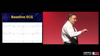 ECG Mini MasterClass Subtle ACS [upl. by Alburg]