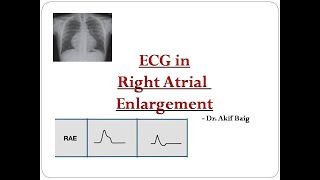 ECG in Right Atrial Enlargement Dr Akif Baig [upl. by Nairolf]