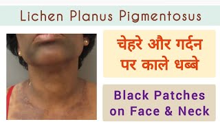 Lichen Planus Pigmentosus चेहरे और गर्दन पर काले धब्बे Black Patches on Face amp Neck pigmentation [upl. by Stretch]