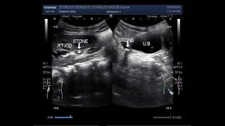 Ultrasound Video showing Tracing of the stone in ureter [upl. by Liamaj701]