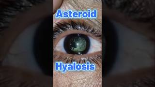 ASTEROID HYALOSIS [upl. by Revert]