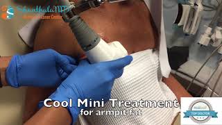 Cool Mini Coolsculpting Treatment for Armpit Fat [upl. by Ransell]