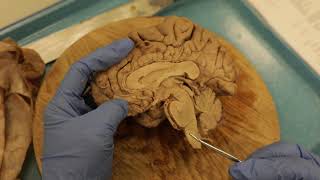 Sagittal Brain Dissection [upl. by Ednutabab]