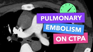 Pulmonary embolism on CTPA  Radiopaedias Emergency Radiology Course [upl. by Neile392]