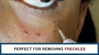 Laser Plasma Pen for Freckle Skin Tag Spot Mole Tattoo Removal  Ortorex [upl. by Utta]