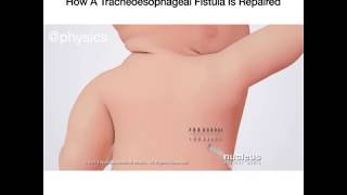 How A Tracheoesophageal Fistula Is Repaired [upl. by Marvella70]