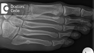 What should one do to speed up the recovery post surgery for Metatarsal Fracture  Dr Mohan M R [upl. by Nylle]