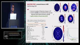 Talk by Dr Santosh Gopi Krishna Gadde on Hyperreflective Foci in Drusens What is the significance [upl. by Lahtnero]