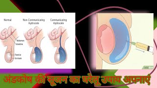 Hydroceleअंडकोष की सूजन से छुटकारा पाएं और अंडकोष में पानी भरने पर देसी इलाज hydocele Right Remedy [upl. by Epoillac343]