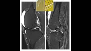 Gouty arthritis VS Degenerative arthritis [upl. by Geilich]