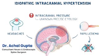 Idiopathic Intracranial Hypertension  Dr Achal Gupta  Neurosurgeon amp Endoscopic Spine Surgeon [upl. by Mireielle]