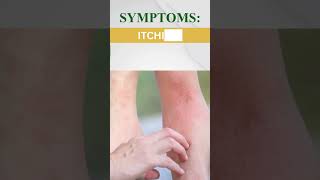 Ichthyosis Treatment  Skin care  Skin Treatment  skincare dermatologist expertdermatologist [upl. by Alexandra]