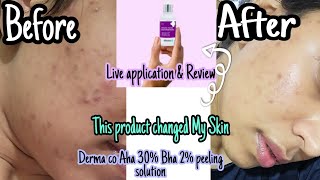 The Derma Co AHA 30 BHA 2 peeling solution review  chemical peeling exfoliation products review [upl. by Bellina160]