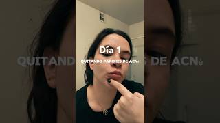 QUITANDO PARCHER DE ACNÉ parchesacne acne acnepositivity acne [upl. by Koby]