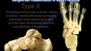 Navicular Fractures  Everything You Need To Know  Dr Nabil Ebraheim [upl. by Dett]