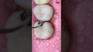 Satisfying Cavity Cleaning ASMR Dental [upl. by Kylah788]