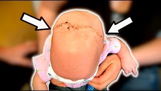 CRANIOSYNOSTOSIS Post Surgery  Dr Paul [upl. by Peck]