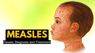 Measles Causes Signs and Symptoms Diagnosis and Treatment [upl. by Ralaigh]