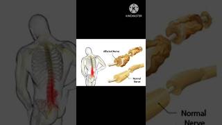 Guillain Barre syndrome disorder detailed key notes with pictures 💃💃✅✅ [upl. by Henrik]