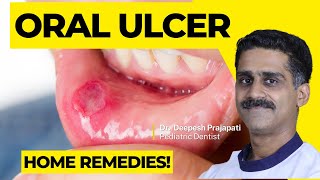 Understanding Oral Ulcers Causes Symptoms and Treatment Options [upl. by Suitangi892]