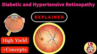 Diabetic and Hypertensive Retinopathy review  شرح مبسط عن اعتلال الشبكية بسبب السكر والضغط [upl. by Aenotna]