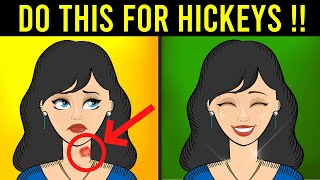 How To Get Rid Of Hickeys Fast Naturally  2022 [upl. by Everick]