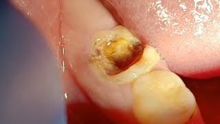 Badly Decayed Lower Molar Six Extraction By Straight Elevator [upl. by Dutch]