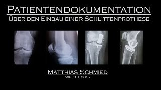 Patientendokumentation über den Einbau einer Schlittenprothese im Knie [upl. by Bigner]