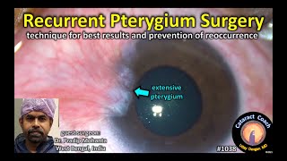 CataractCoach 1038 recurrent pterygium surgery [upl. by Buckler226]