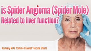 Spider Mole  Spider angioma  and liver function shorts angioma spiderangioma [upl. by Dennison]