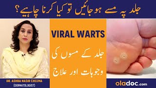 Viral Warts Causes amp Treatment  Skin Ke Masse Ka Ilaj  Warts On Face Hand amp Feet Removal [upl. by Kaela]