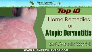 Top 10 Home Remedies For Atopic Dermatitis Eczema That Actually Work [upl. by Macintyre631]