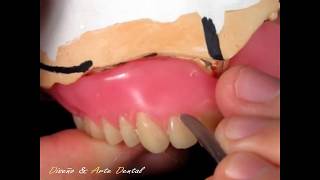 1  🔴 FORMAS DE LOS CUELLOS 🔴 en protesis total dental FESTONEADO [upl. by Yllaw]