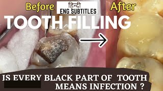 3 Tooth filling in one tooth  GIC filling Dentin Replacement Injectable filling  Cavity filling [upl. by Ciredor]