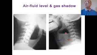 Retropharyngeal abscess Prevertebral abscess Acute n chronic retropharyngeal abscess [upl. by Kalam]