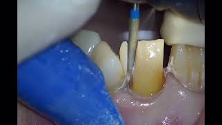 Zirconia ceramic preparation for anterior teeth [upl. by Imim535]