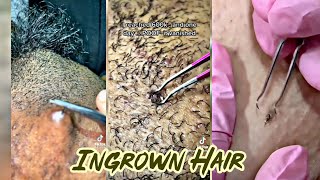 Removing Ingrown Hair Compilation  Body Care Compilation 👣 [upl. by Econah]