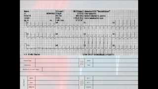 12 Lead Interpretation Part 62 EKG Changes and Lead Localization of Myocardial Infarctions [upl. by Maillw]