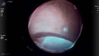 Pseudophakic retinal detachment in vitrectomized eye Vista Live Stream [upl. by Mundford]