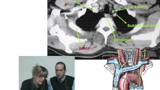 Endokrin Cerrahide Boyun ve Toraks BT Yorumlaması [upl. by Lamson]