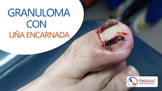 😱 ¿Cómo Extraer GRANULOMA con UÑA ENCARNADA 🔴 [upl. by Nudnarb]