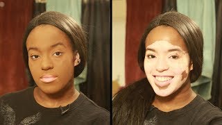 I Won’t Hide My Vitiligo With Makeup  SHAKE MY BEAUTY [upl. by Shewchuk]