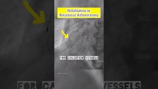 Rotablation rotational Atherectomy angiogram angioplasty cardiology heart shorts [upl. by Leavy334]