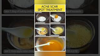 Home Remedies For Acne And Pimples ❤️❣️skincare acnetreatment shortvideo [upl. by Berman]