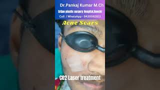 Acne scar treatment by CO2 Laser Laser treatment of Acne scar Acne scar treatment in Ranchi scar [upl. by Nnylidnarb114]