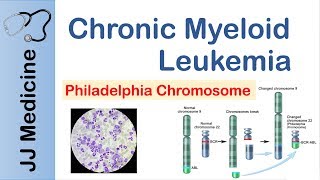 Chronic Myeloid Leukemia CML  Pathogenesis Symptoms and Treatment [upl. by Yerok823]