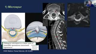 EANS Webinars CSFvenous fistulas – how do I find them And how are they treated [upl. by Rayshell]